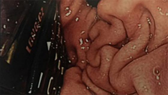 استخراج نقال صالح للاستعمال من بطن سجين ابتلعه.. بعد شق بطنه!! صورة رقم 2