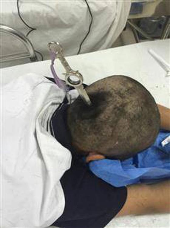 صور مروعة لسكين تخترق راس طفلة كادت تنهي حياتها صورة رقم 2