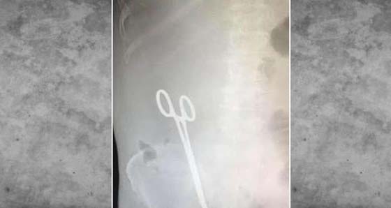 مقص في احشاء مريض سعودي نسيه الاطباء من عملية سابقة صورة رقم 1