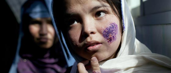 سوريا تصدر وباءً خطيرا الى الشرق الاوسط.. تنقله ذبابة الرمل صورة رقم 6