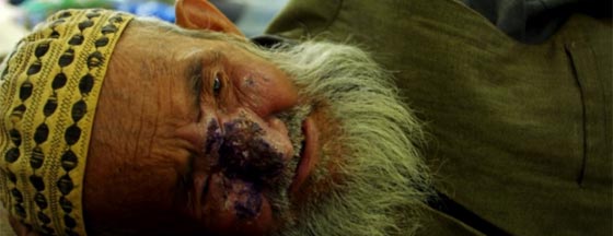 سوريا تصدر وباءً خطيرا الى الشرق الاوسط.. تنقله ذبابة الرمل صورة رقم 2