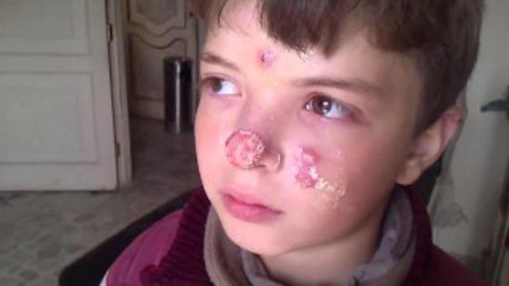 سوريا تصدر وباءً خطيرا الى الشرق الاوسط.. تنقله ذبابة الرمل صورة رقم 7