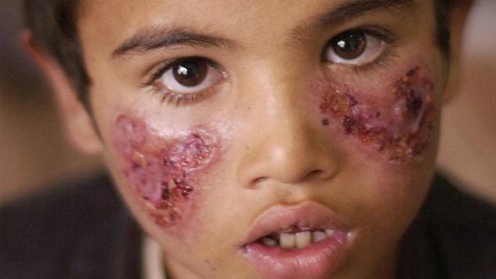 سوريا تصدر وباءً خطيرا الى الشرق الاوسط.. تنقله ذبابة الرمل صورة رقم 9