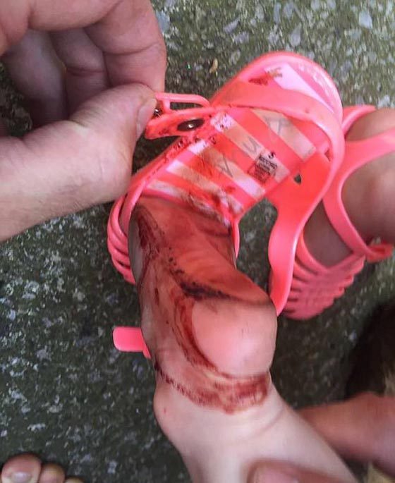  صور مرعبة.. شاهد ما فعله حذاء بلاستيكي بقدم طفلة صورة رقم 1