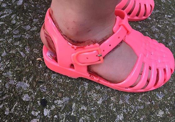  صور مرعبة.. شاهد ما فعله حذاء بلاستيكي بقدم طفلة صورة رقم 2