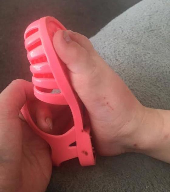  صور مرعبة.. شاهد ما فعله حذاء بلاستيكي بقدم طفلة صورة رقم 4