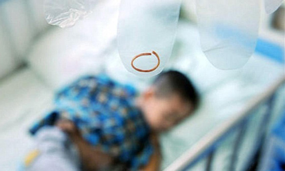 شريط مطاطي ينمو داخل جلد طفل كاد يتسبب بقطع يده! صورة رقم 4