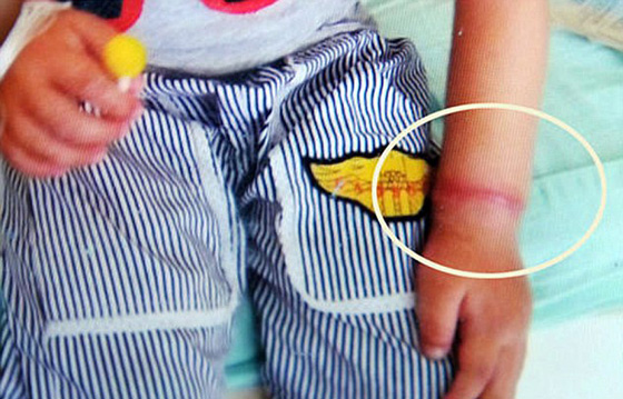 شريط مطاطي ينمو داخل جلد طفل كاد يتسبب بقطع يده! صورة رقم 2