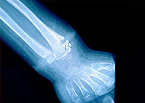 شريط مطاطي ينمو داخل جلد طفل كاد يتسبب بقطع يده! صورة رقم 3