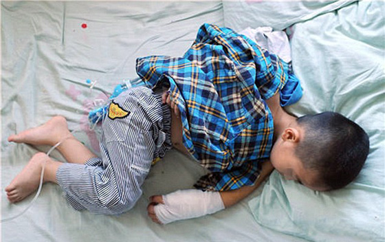 شريط مطاطي ينمو داخل جلد طفل كاد يتسبب بقطع يده! صورة رقم 1