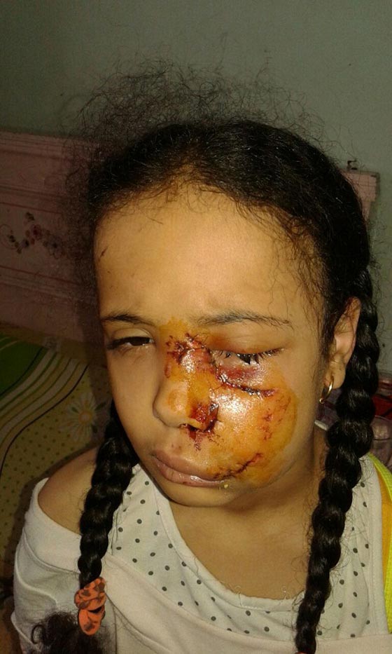 صور: كلاب شرسة تهشم وجه طفلة مصرية وتشوه جسدها بعد صلاة التراويح  صورة رقم 2
