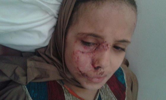 صور: كلاب شرسة تهشم وجه طفلة مصرية وتشوه جسدها بعد صلاة التراويح  صورة رقم 4