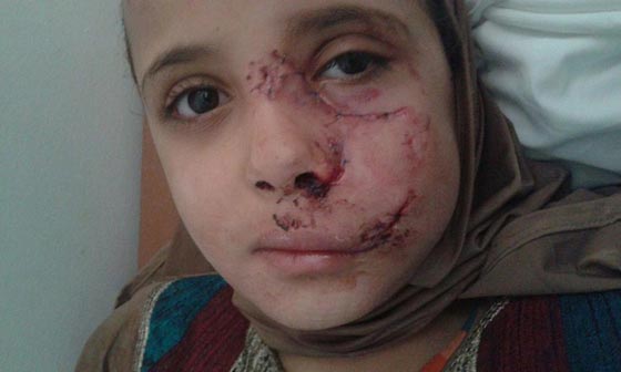 صور: كلاب شرسة تهشم وجه طفلة مصرية وتشوه جسدها بعد صلاة التراويح  صورة رقم 1