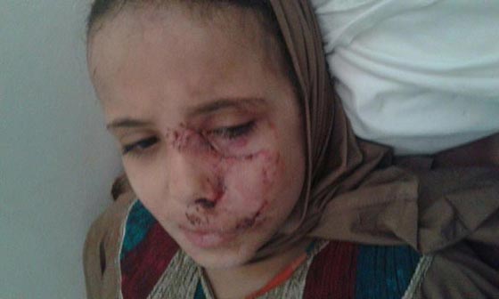 صور: كلاب شرسة تهشم وجه طفلة مصرية وتشوه جسدها بعد صلاة التراويح  صورة رقم 5