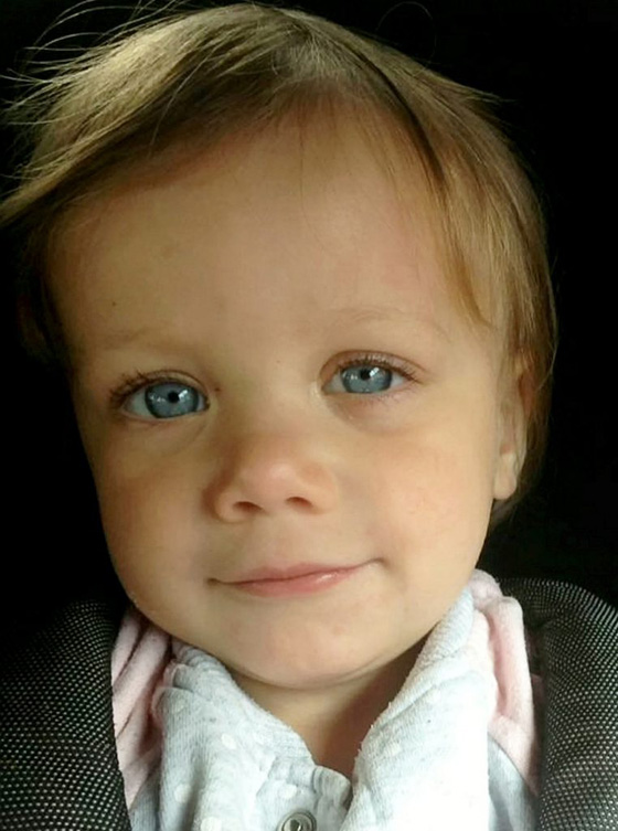 حادث رهيب.. مسحوق الغسيل يشوه  وجه طفلة بنسبة 95%  صورة رقم 5