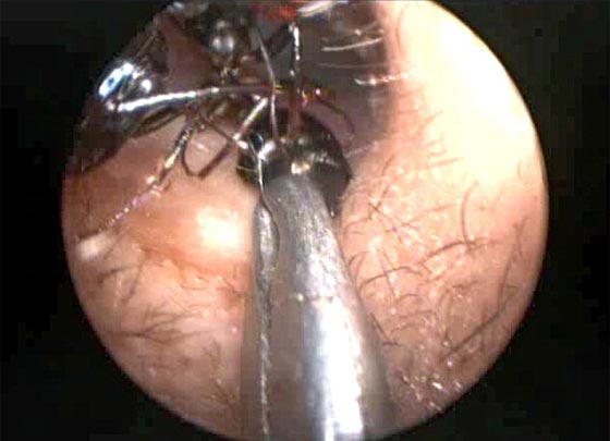 اكثر من الف نملة تعشش في اذن طفلة صغيرة.. شاهد الفيديو صورة رقم 5 اكثر من الف نملة تعشش في اذن طفلة صغيرة.. شاهد الفيديو صورة رقم 5