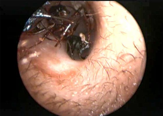 اكثر من الف نملة تعشش في اذن طفلة صغيرة.. شاهد الفيديو صورة رقم 4 اكثر من الف نملة تعشش في اذن طفلة صغيرة.. شاهد الفيديو صورة رقم 4