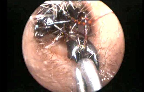 اكثر من الف نملة تعشش في اذن طفلة صغيرة.. شاهد الفيديو صورة رقم 6 اكثر من الف نملة تعشش في اذن طفلة صغيرة.. شاهد الفيديو صورة رقم 6