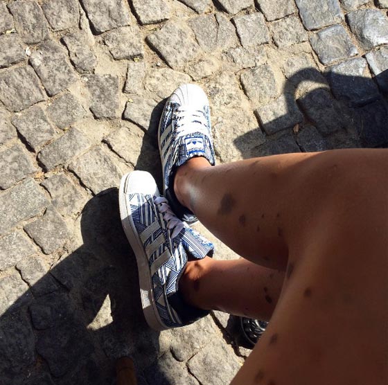 حسناء تغطي جسدها الوحمات وتتحدى بثقة كبيرة لقب الكلب المنقط! صورة رقم 6