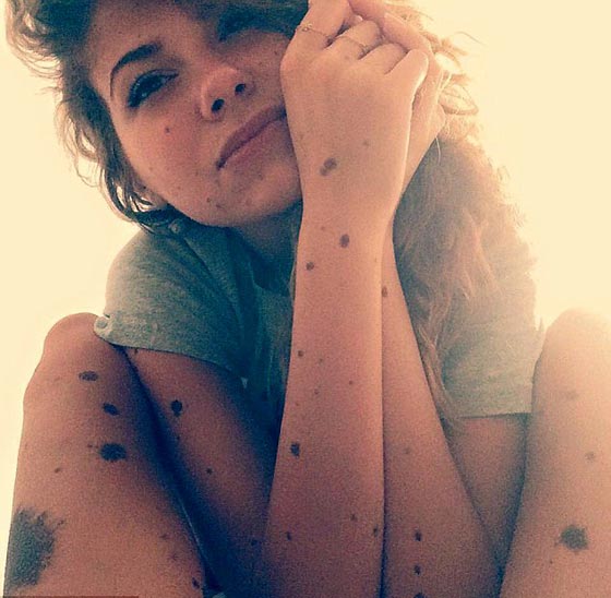 حسناء تغطي جسدها الوحمات وتتحدى بثقة كبيرة لقب الكلب المنقط! صورة رقم 7