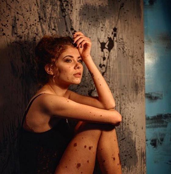 حسناء تغطي جسدها الوحمات وتتحدى بثقة كبيرة لقب الكلب المنقط! صورة رقم 14