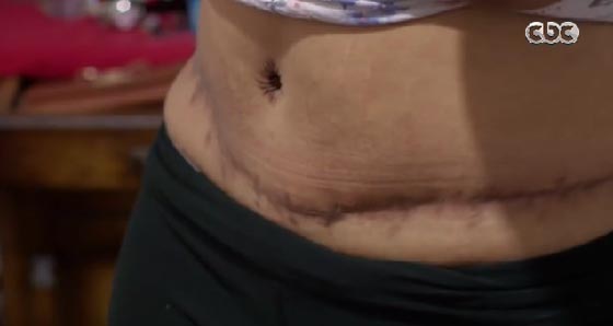 فيديو صادم: اجرت عملية تجميل شفط دهون فشوه الطبيب جسدها صورة رقم 6 فيديو صادم: اجرت عملية تجميل شفط دهون فشوه الطبيب جسدها صورة رقم 6