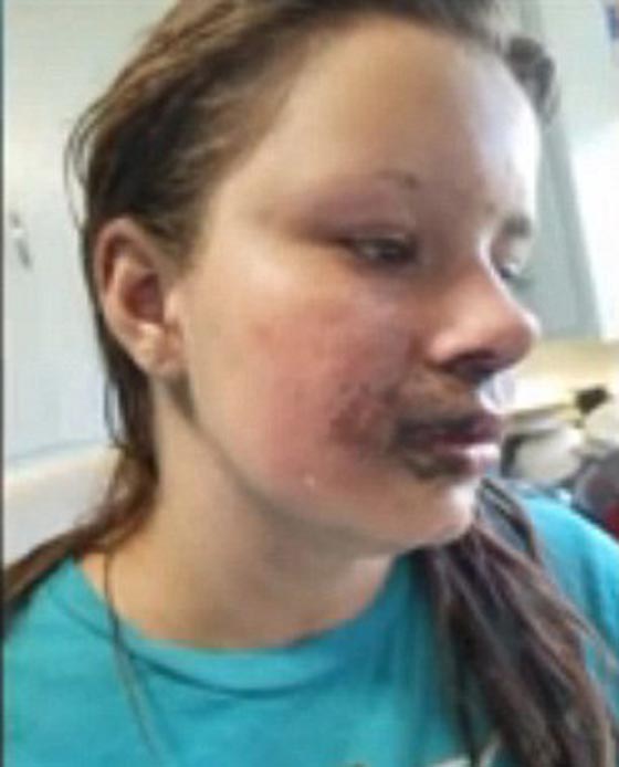 صور فتاة انفجرت في  وجهها سيجارة الكترونية صورة رقم 2