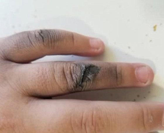 صور فتاة انفجرت في  وجهها سيجارة الكترونية صورة رقم 3