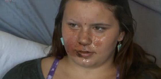 صور فتاة انفجرت في  وجهها سيجارة الكترونية صورة رقم 1