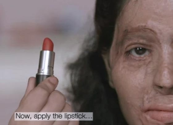 فتاة هندية مشوهه أصبحت وجها إعلاميا لمنع بيع المواد الحارقة!  صورة رقم 1