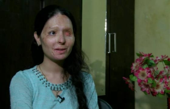 فتاة هندية مشوهه أصبحت وجها إعلاميا لمنع بيع المواد الحارقة!  صورة رقم 3
