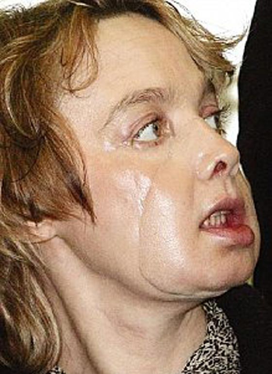  بسبب السرطان، وفاة اول سيدة اجرت عملية زراعة وجه في العالم صورة رقم 3