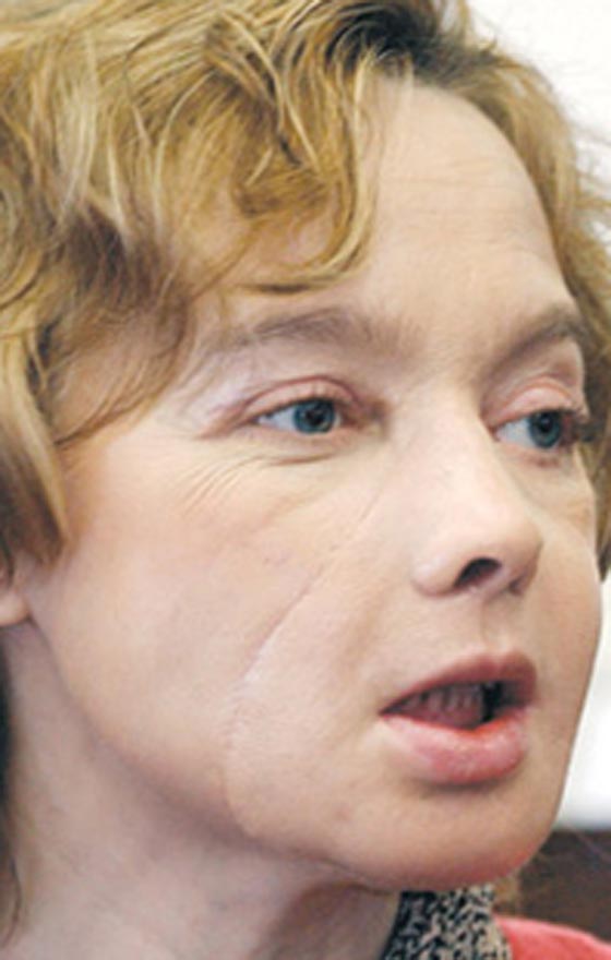  بسبب السرطان، وفاة اول سيدة اجرت عملية زراعة وجه في العالم صورة رقم 4