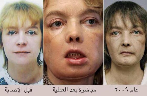  بسبب السرطان، وفاة اول سيدة اجرت عملية زراعة وجه في العالم صورة رقم 1