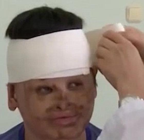 نأى بنفسه بسبب شكله المشوه.. زراعة وجه لرجل من جلد معدته صورة رقم 3