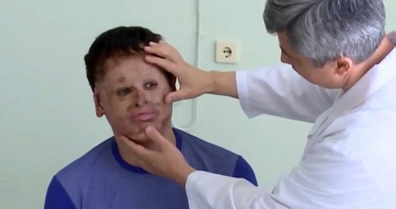 نأى بنفسه بسبب شكله المشوه.. زراعة وجه لرجل من جلد معدته صورة رقم 4