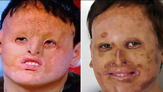 نأى بنفسه بسبب شكله المشوه.. زراعة وجه لرجل من جلد معدته صورة رقم 1