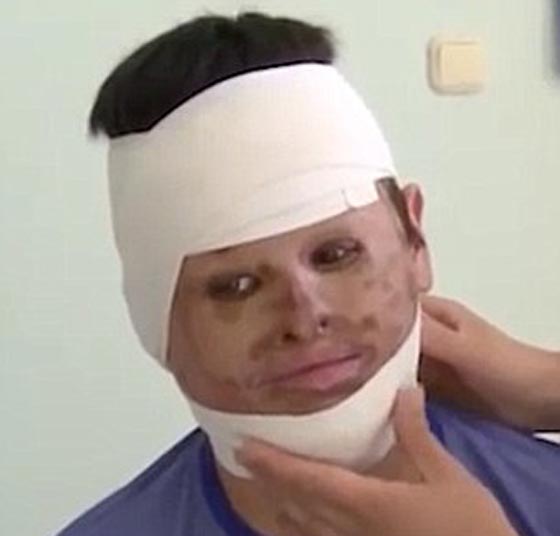 نأى بنفسه بسبب شكله المشوه.. زراعة وجه لرجل من جلد معدته صورة رقم 2