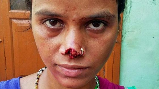 هندي مخمور يقطع أنف زوجته عقابا لاهلها لعدم دفع المهر! صورة رقم 3