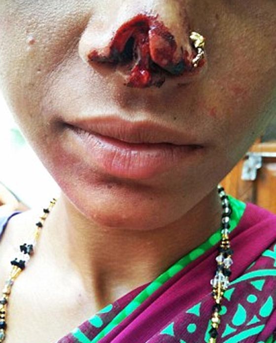 هندي مخمور يقطع أنف زوجته عقابا لاهلها لعدم دفع المهر! صورة رقم 4