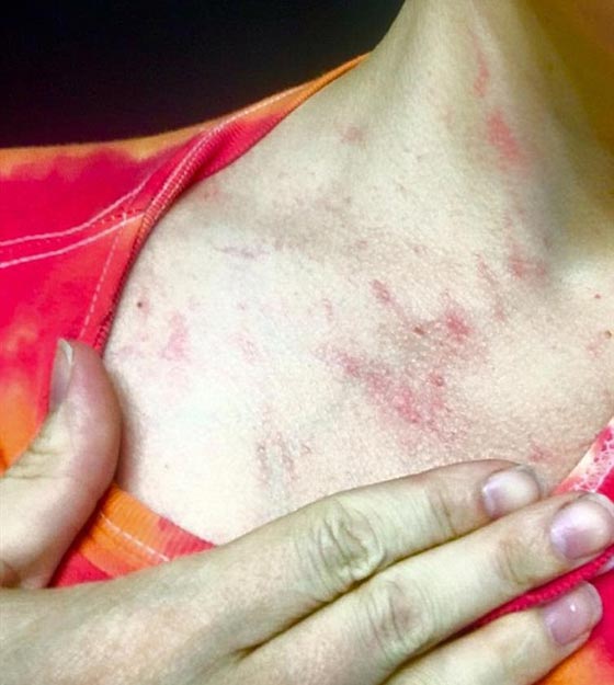 هل يعقل؟! امرأة تعاني نوعا من الحساسية للمياه صورة رقم 2