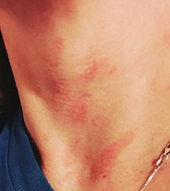 هل يعقل؟! امرأة تعاني نوعا من الحساسية للمياه صورة رقم 4