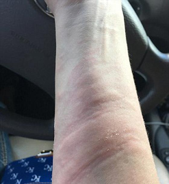 هل يعقل؟! امرأة تعاني نوعا من الحساسية للمياه صورة رقم 5