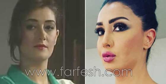 صور فنانات اجرين عمليات تجميل فاشلة نجم عنها التشويه الشلل والوفاة  صورة رقم 5