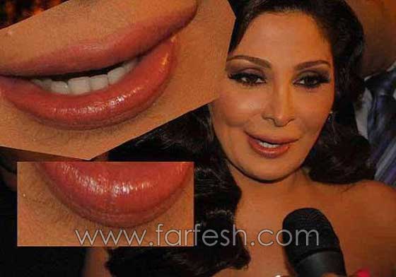 صور فنانات اجرين عمليات تجميل فاشلة نجم عنها التشويه الشلل والوفاة  صورة رقم 15
