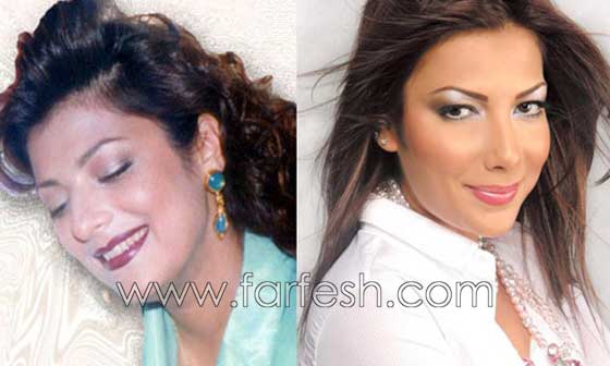 صور فنانات اجرين عمليات تجميل فاشلة نجم عنها التشويه الشلل والوفاة  صورة رقم 3
