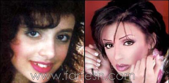 صور فنانات اجرين عمليات تجميل فاشلة نجم عنها التشويه الشلل والوفاة  صورة رقم 10