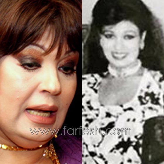 صور فنانات اجرين عمليات تجميل فاشلة نجم عنها التشويه الشلل والوفاة  صورة رقم 8