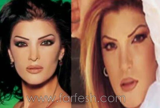 صور فنانات اجرين عمليات تجميل فاشلة نجم عنها التشويه الشلل والوفاة  صورة رقم 13