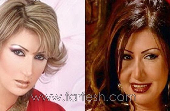 صور فنانات اجرين عمليات تجميل فاشلة نجم عنها التشويه الشلل والوفاة  صورة رقم 12